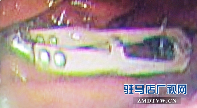 這一幕看呆醫(yī)生！男子胃里竟然有把剪刀！