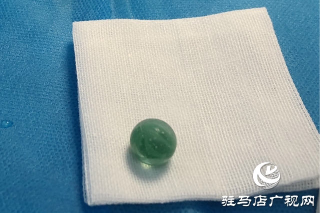 女童下體誤塞異物 醫(yī)生手術安全取出