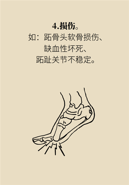 前腳掌起老繭并疼痛？當心這可能是跖痛癥