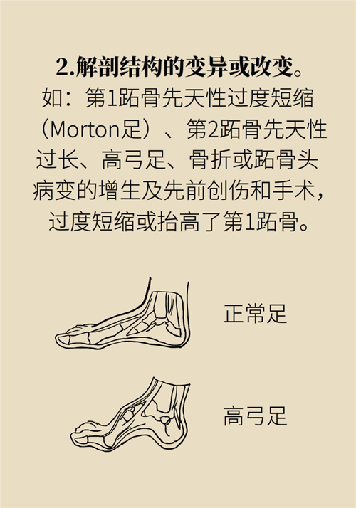 前腳掌起老繭并疼痛？當心這可能是跖痛癥