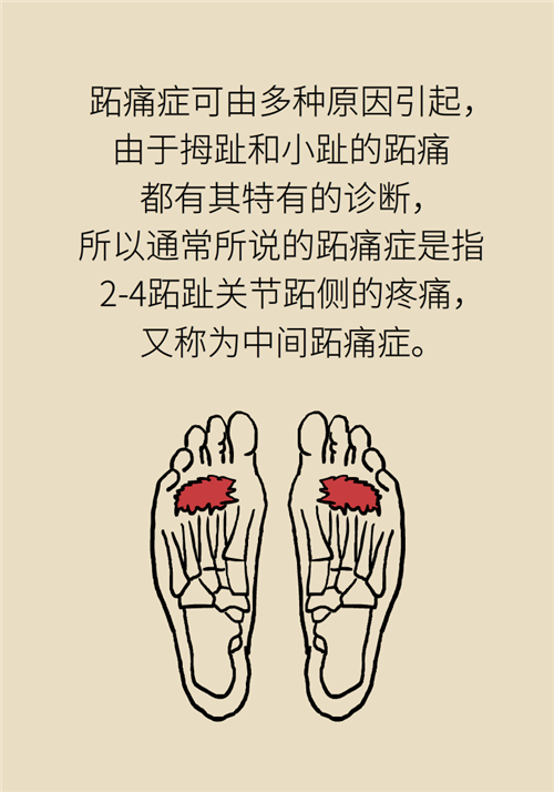 前腳掌起老繭并疼痛？當心這可能是跖痛癥