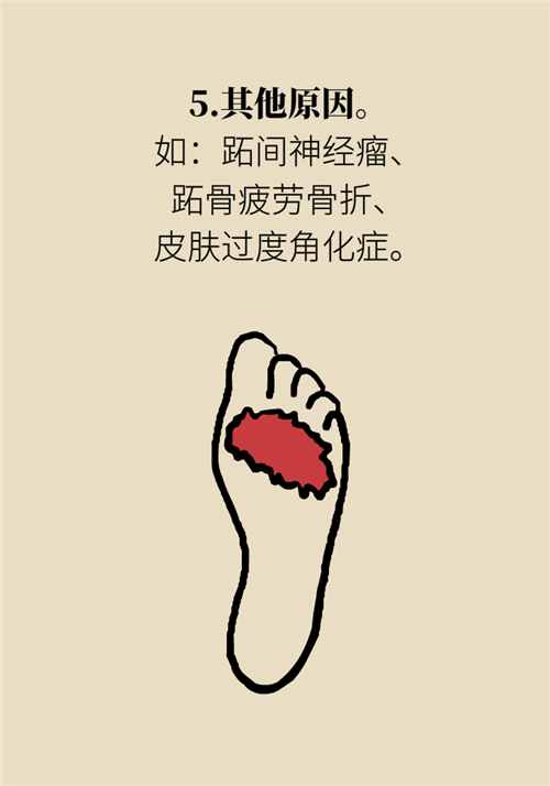 前腳掌起老繭并疼痛？當心這可能是跖痛癥