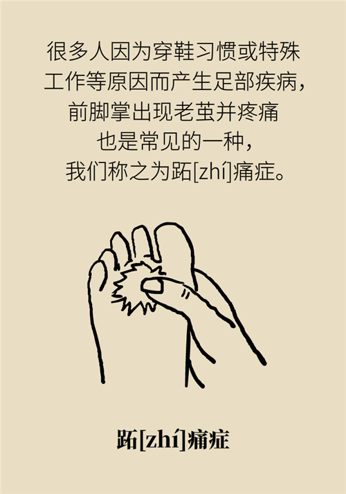 前腳掌起老繭并疼痛？當心這可能是跖痛癥