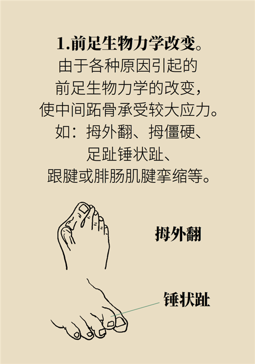 前腳掌起老繭并疼痛？當心這可能是跖痛癥