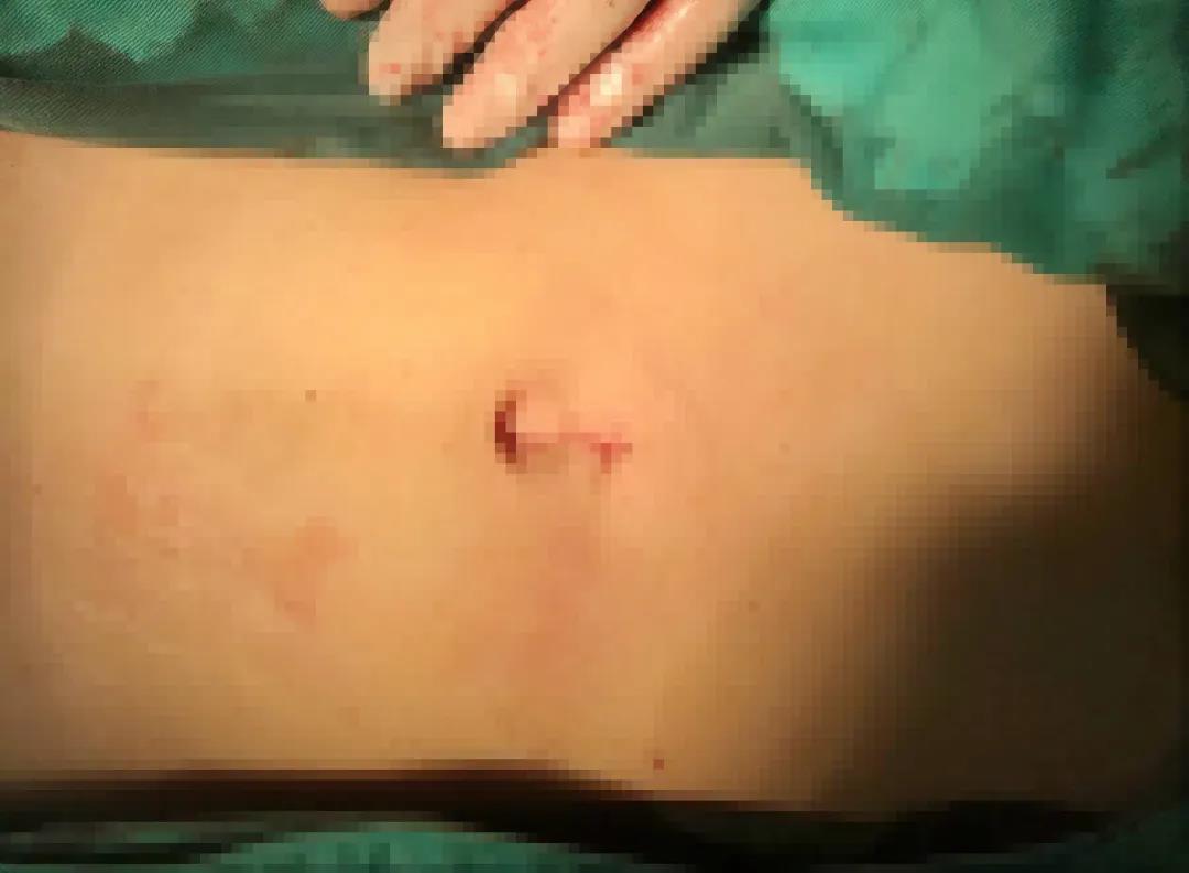 患者千里迢迢回家鄉(xiāng)就醫(yī) 精心救治不負(fù)君來(lái)不負(fù)卿