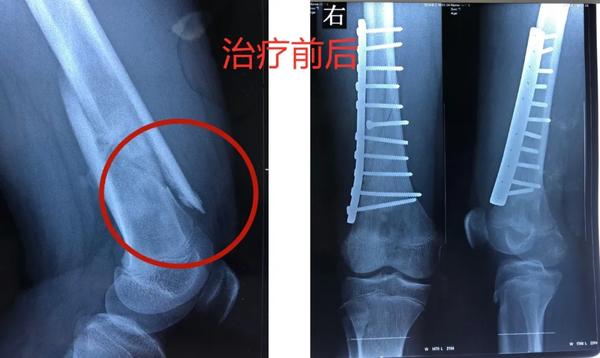 兒童這種“骨折”要警惕，可能是癌癥的預警信號