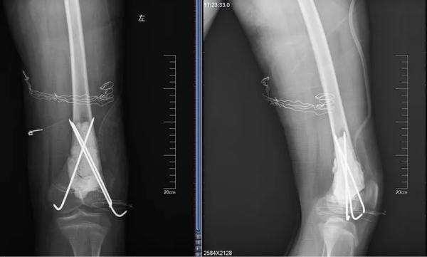 兒童這種“骨折”要警惕，可能是癌癥的預警信號