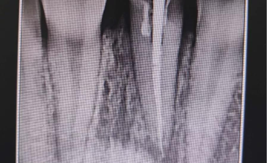 門牙折斷&ldquo;多丑&rdquo; 口腔亞?？茣?huì)診讓它重塑美麗