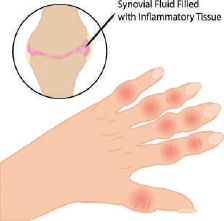 得了類(lèi)風(fēng)濕關(guān)節(jié)炎還能運(yùn)動(dòng)嗎