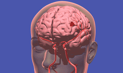 腦梗高發(fā)季到了！有3種不舒服，千萬別大意