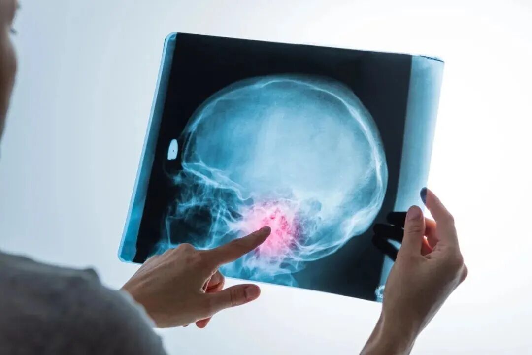 腦梗高發(fā)季到了！有3種不舒服，千萬別大意