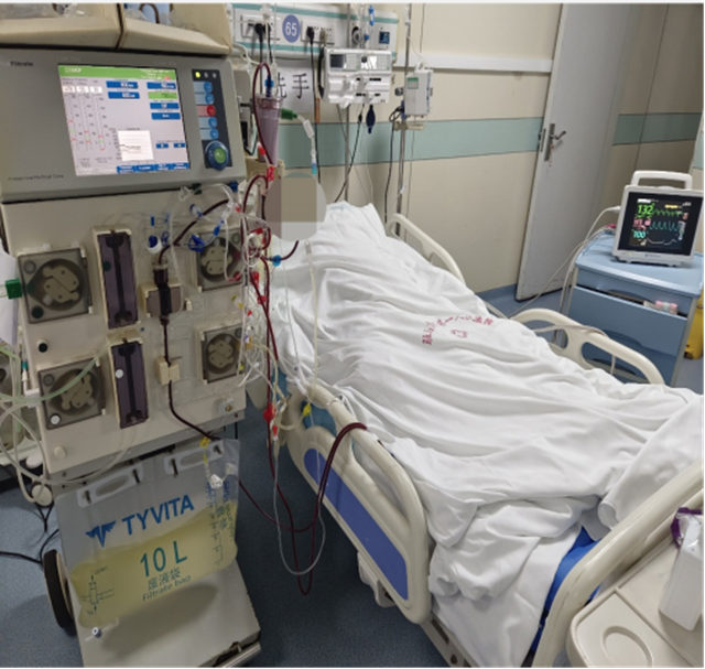 重癥醫(yī)學(xué)科聯(lián)合血液凈化科成功救治腎衰合并心衰患者  床旁連續(xù)血液凈化治療顯威力，危急時刻守護(hù)生命