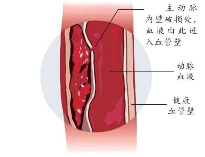防寒更要防病！醫(yī)生提醒：別讓低溫“凍”破主動脈