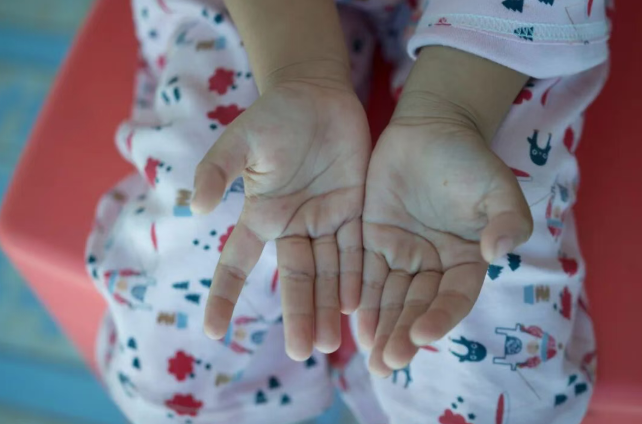 關(guān)于手足口病的8個常見誤區(qū)，一次說清！