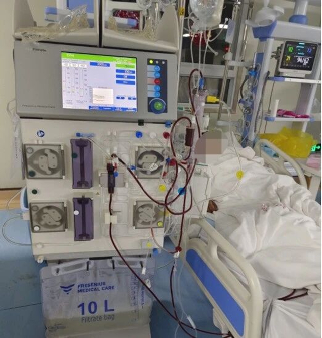 重癥膿毒血癥患者急性腎衰竭，床旁血液凈化技術(shù)成功救治