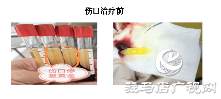 【新技術(shù)】PRF自體修復(fù)技術(shù)喚醒傷口自愈力 快愈無(wú)痕更舒心