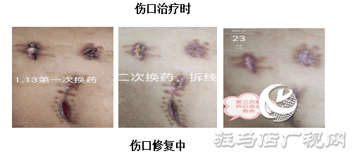 【新技術(shù)】PRF自體修復(fù)技術(shù)喚醒傷口自愈力 快愈無(wú)痕更舒心