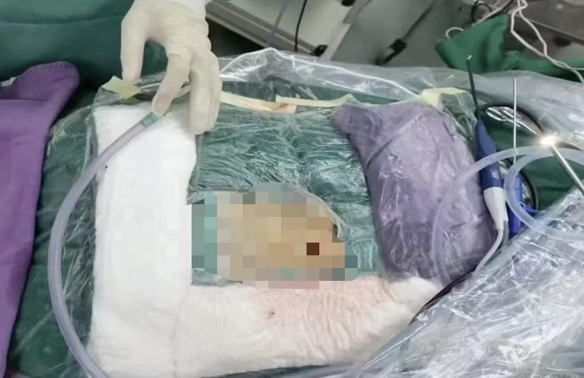 駐馬店市中醫(yī)院成功實(shí)施UBE微創(chuàng)手術(shù)，助腰腿痛患者重獲健康