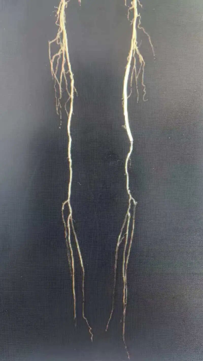 低溫危機(jī)！七旬老人腳部潰爛無法行走竟因這個(gè)病