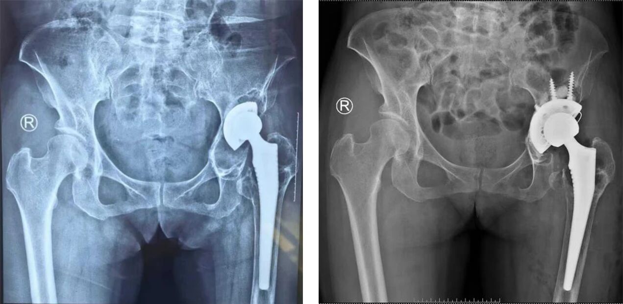 假體松動(dòng)不用愁！髖關(guān)節(jié)翻修術(shù)為患者重啟穩(wěn)固人生