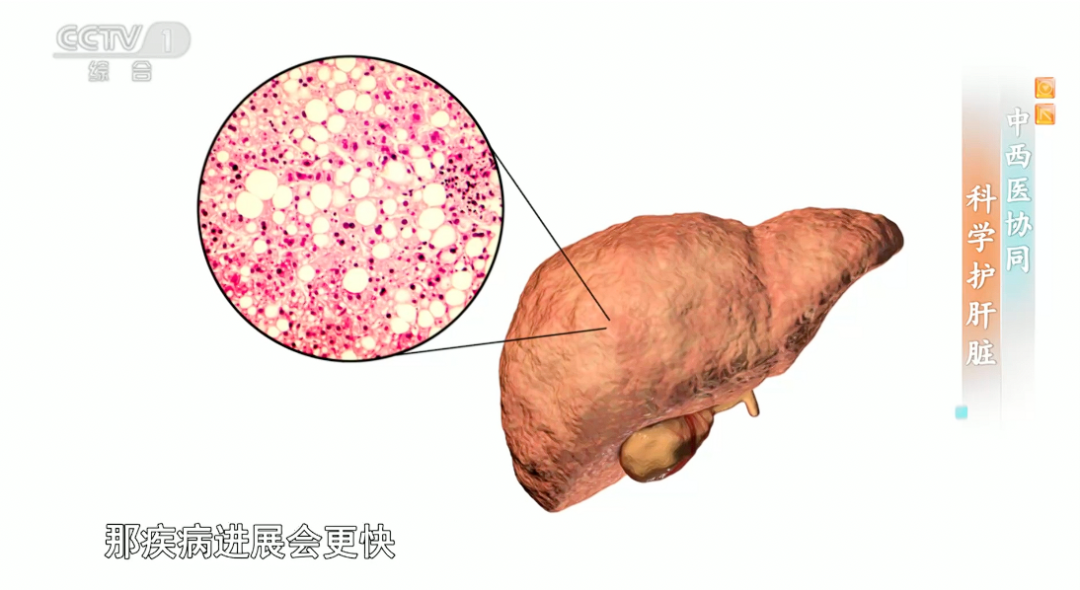 研究發(fā)現(xiàn)：45歲前患上脂肪肝的人，多年后更易得癌